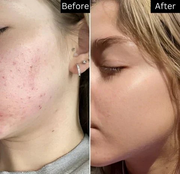 The Ordinary - Niacinamide 10% + Zinc 1% - 30ml